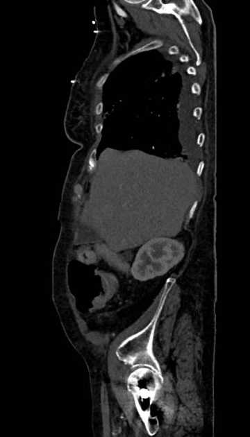 Abdominal aortic aneurysm with thrombus fissuration (Radiopaedia 73192-83919 Sagittal C+ arterial phase 117).jpg