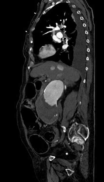 Abdominal aortic aneurysm with thrombus fissuration (Radiopaedia 73192-83919 Sagittal C+ arterial phase 89).jpg