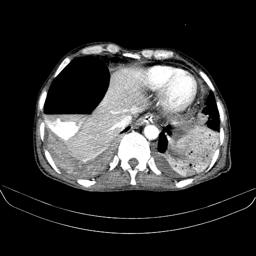 File:Abdominal collection due to previous cecal perforation (Radiopaedia 80831-94320 Axial C+ portal venous phase 23).jpg