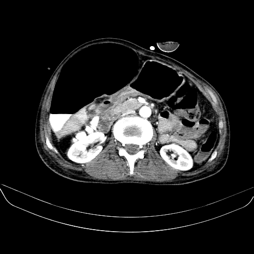 File:Abdominal collection due to previous cecal perforation (Radiopaedia 80831-94320 Axial C+ portal venous phase 86).jpg