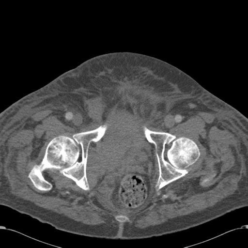 Abdominal hematoma (Radiopaedia 33614-34715 Axial C+ portal venous phase 127).png