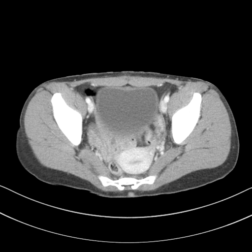 File:Abdominal multi-trauma - devascularised kidney and liver, spleen and pancreatic lacerations (Radiopaedia 34984-36486 Axial C+ portal venous phase 71).png