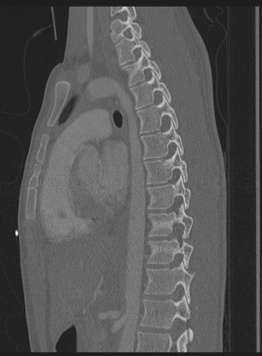 Abdominal multi-trauma - devascularised kidney and liver, spleen and pancreatic lacerations (Radiopaedia 34984-36486 Sagittal bone window 26).png