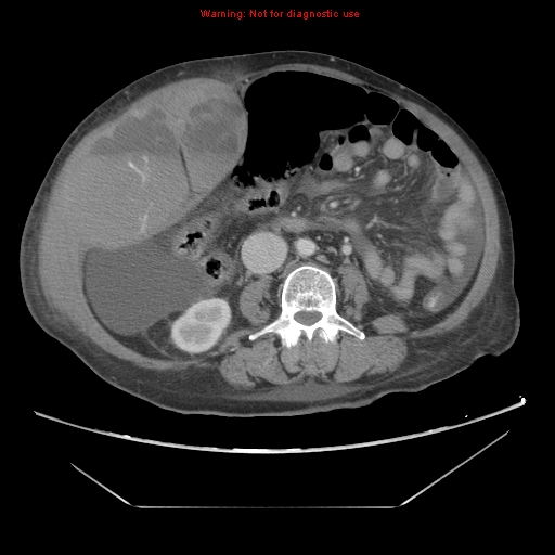 File:Abdominal wall hematoma (Radiopaedia 9427-10112 Axial C+ portal venous phase 56).jpg