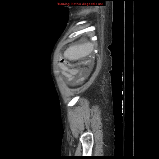Abdominal wall hematoma (Radiopaedia 9427-10112 Sagittal C+ portal venous phase 13).jpg