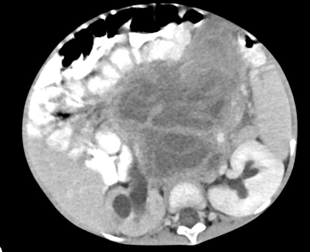 Abdominopelvic rhabdomyosarcoma (Radiopaedia 78356-90984 Axial C+ portal venous phase 77).jpg