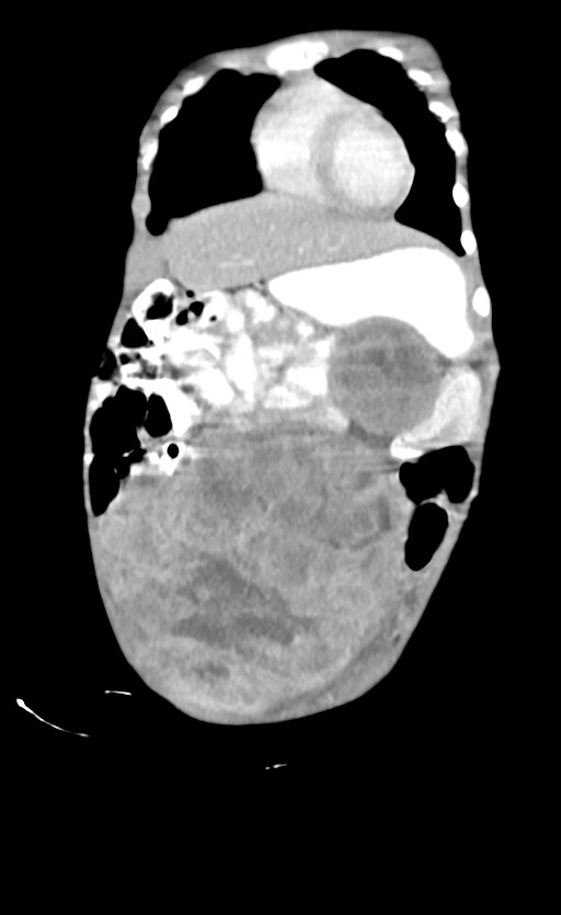 Abdominopelvic rhabdomyosarcoma (Radiopaedia 78356-90984 Coronal C+ portal venous phase 20).jpg