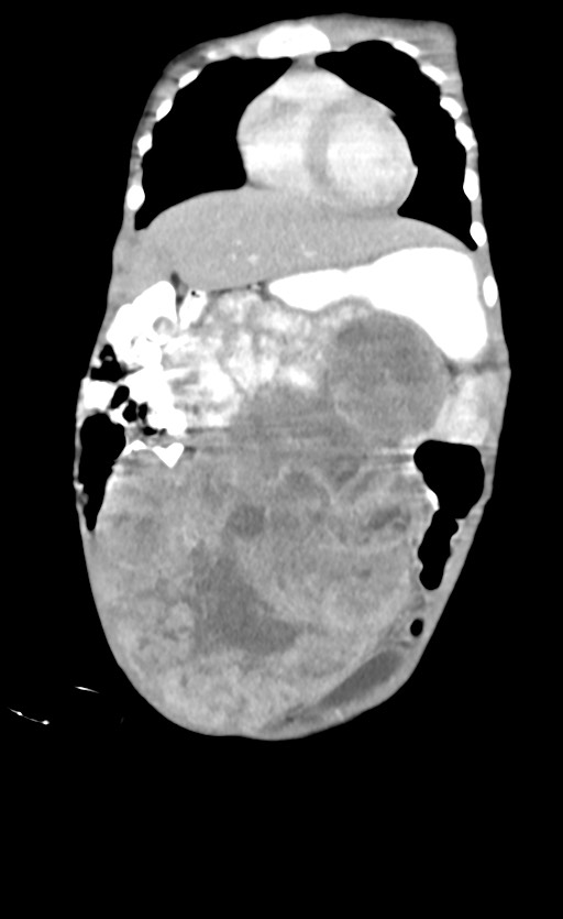 Abdominopelvic rhabdomyosarcoma (Radiopaedia 78356-90984 Coronal C+ portal venous phase 23).jpg
