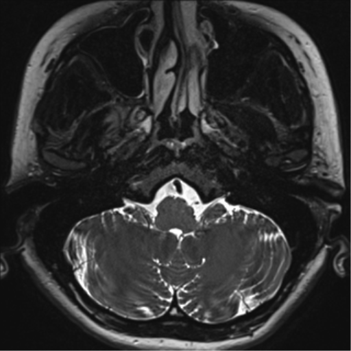 Abducens nerve palsy (Radiopaedia 51069-56648 Axial T2 fat sat 4).png