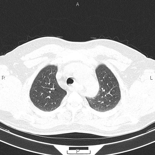 File:Aberrant right subclavian artery (Radiopaedia 87093-103354 Axial lung window 25).jpg