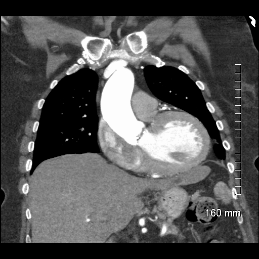 Aberrant right subclavian artery stenosis (Radiopaedia 52656-58670 B 36).jpg