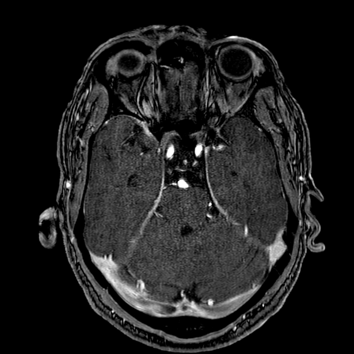 Accessory middle cerebral artery (Radiopaedia 73114-83828 Axial MRA 60).jpg