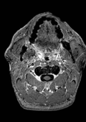 Accessory middle cerebral artery (Radiopaedia 73114-83828 Axial T1 C+ 244).jpg