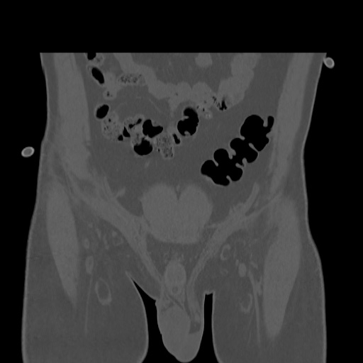 Acetabular and ilial fractures (Radiopaedia 59084-66378 Coronal bone window 6).jpg
