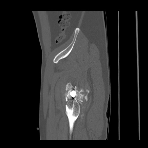 Acetabular and ilial fractures (Radiopaedia 59084-66378 Sagittal bone window 86).jpg