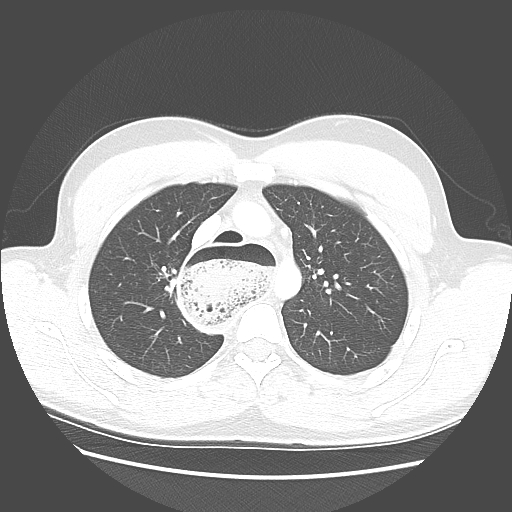 Achalasia (Radiopaedia 52507-58417 Axial lung window 20).jpg