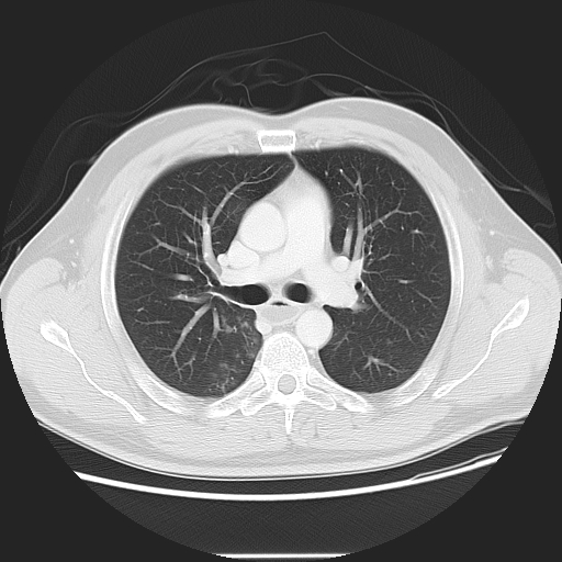 Achalasia (Radiopaedia 8831-9629 Axial lung window 27).jpg