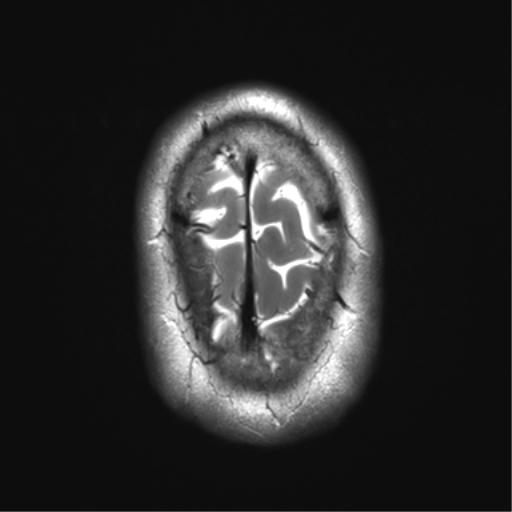 File:Achondroplasia (Radiopaedia 65109-74105 Axial T2 37).png