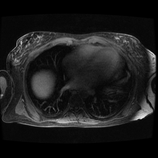 Acinar cell carcinoma of the pancreas (Radiopaedia 75442-86668 Axial late phase (~30 mins) 144).jpg
