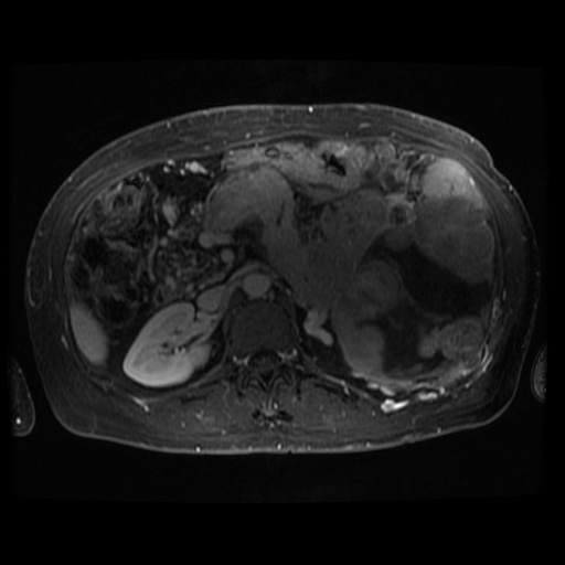 Acinar cell carcinoma of the pancreas (Radiopaedia 75442-86668 D 49).jpg