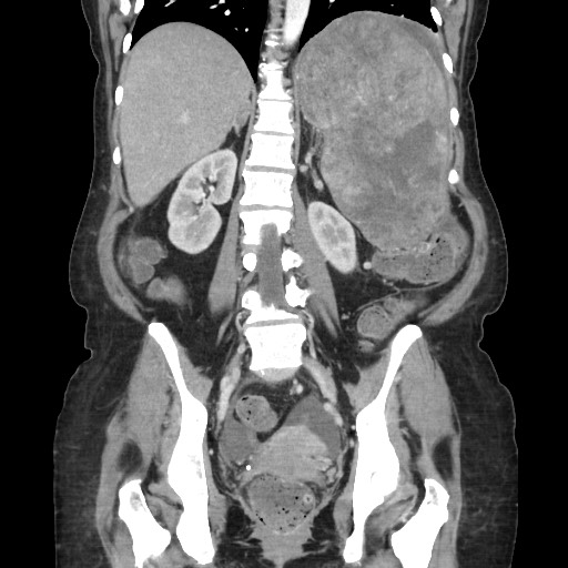 File:Acinar cell carcinoma of the pancreas (Radiopaedia 75442-86669 Coronal C+ portal venous phase 83).jpg
