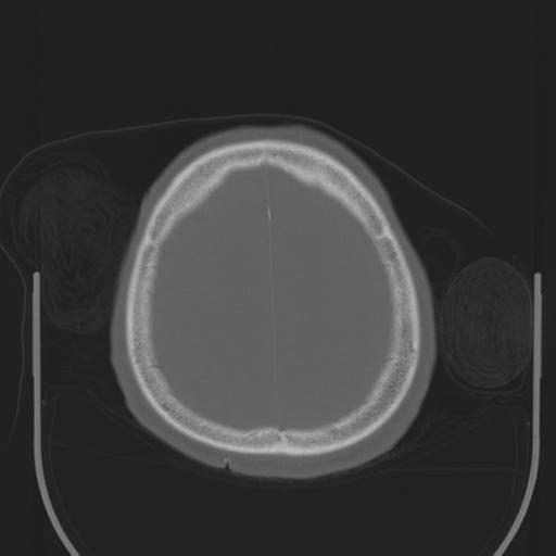 File:Acoustic schwannoma (Radiopaedia 29488-29982 AXIAL BONE THICK non-contrast 41).jpg