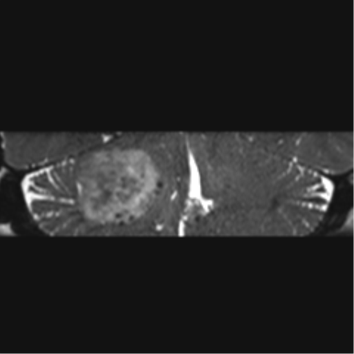 File:Acoustic schwannoma (Radiopaedia 50846-56358 Coronal T2 14).png