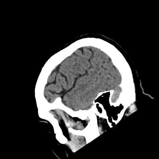 File:Acoustic schwannoma (Radiopaedia 55729-62280 Sagittal non-contrast 6).png