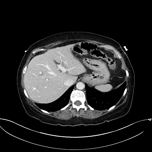 Active Crohn disease (Radiopaedia 59394-66750 Axial C+ portal venous phase 15).jpg