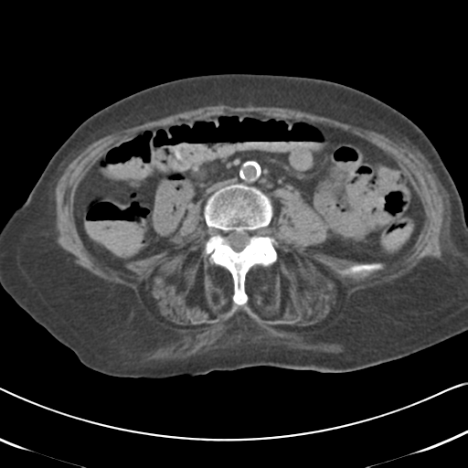 File:Active bleeding from duodenal ulcer with embolization (Radiopaedia 34216-35481 Axial non-contrast 36).png