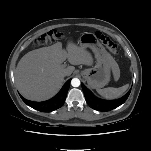 Active colonic bleed on CT (Radiopaedia 49765-55025 Axial C+ arterial phase 18).jpg