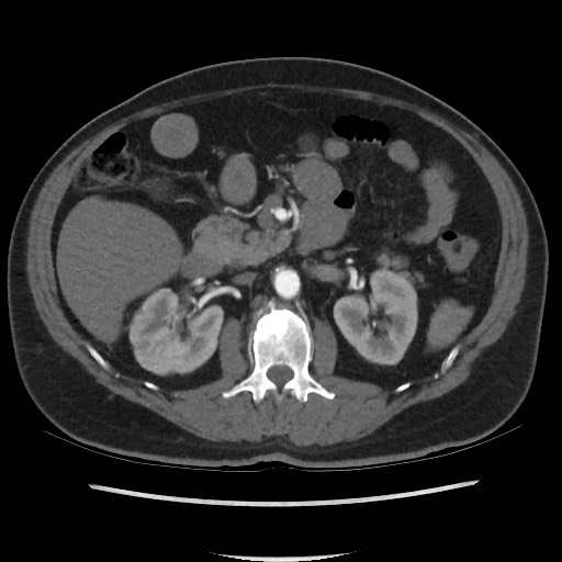 File:Active colonic bleed on CT (Radiopaedia 49765-55025 Axial C+ arterial phase 33).jpg