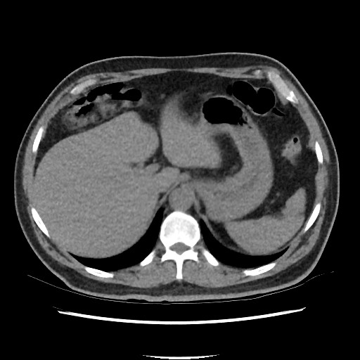 Active colonic bleed on CT (Radiopaedia 49765-55025 Axial non-contrast 15).jpg