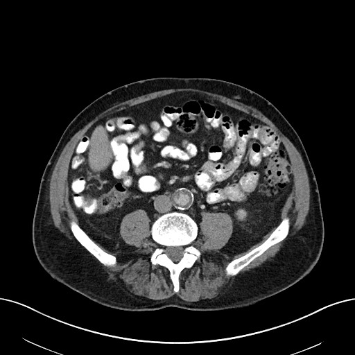 Active lower gastrointestinal bleeding - diverticular (Radiopaedia 61203-69106 Axial C+ portal venous phase 75).jpg
