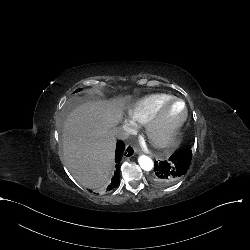 File:Active renal extravasation with large subcapsular and retroperitoneal hemorrhage (Radiopaedia 60975-68796 Axial 173).jpg
