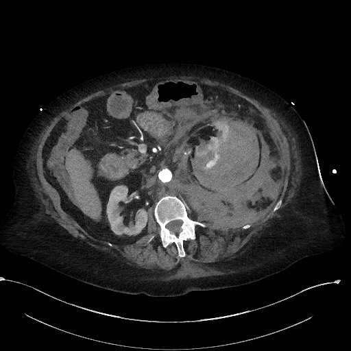 Active renal extravasation with large subcapsular and retroperitoneal hemorrhage (Radiopaedia 60975-68796 Axial C+ arterial phase 80).jpg