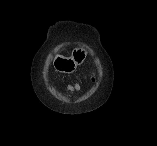 File:Active renal extravasation with large subcapsular and retroperitoneal hemorrhage (Radiopaedia 60975-68796 Coronal C+ portal venous phase 21).jpg