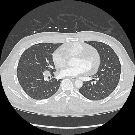File:Active right ventricular cardiac sarcoidosis (Radiopaedia 55596-62101 Axial lung window 26).jpg