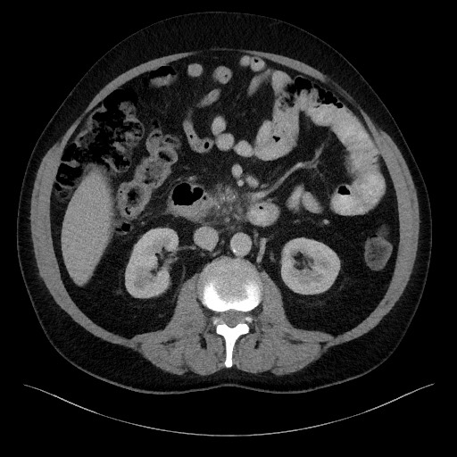 File:Acute-on-chronic pancreatitis (Radiopaedia 67286-76656 Axial C+ portal venous phase 36).jpg