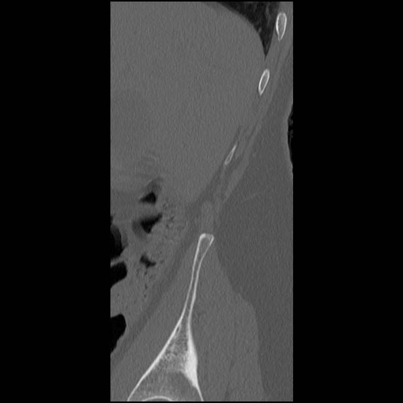 Acute Schmorl's node (Radiopaedia 83276-102365 Sagittal bone window 79).jpg