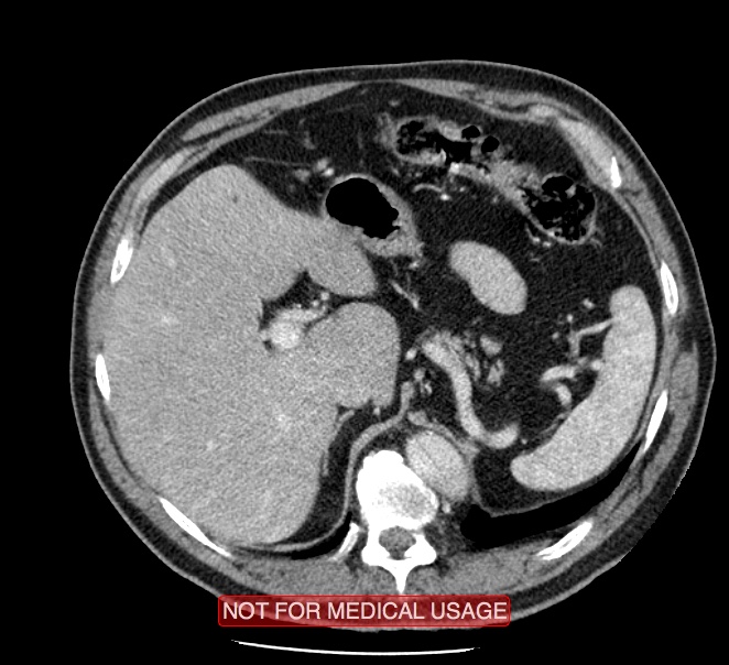 Acute aortic dissection - Stanford type A (Radiopaedia 40661-43285 Axial C+ portal venous phase 69).jpg