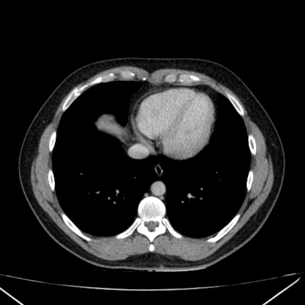 File:Acute appendicitis (Radiopaedia 38255-40270 Axial C+ portal venous phase 2).jpg