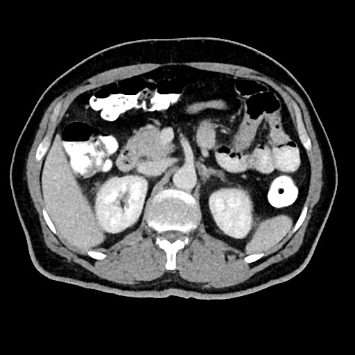 Acute appendicitis (Radiopaedia 77016-88960 Axial C+ portal venous phase 51).jpg