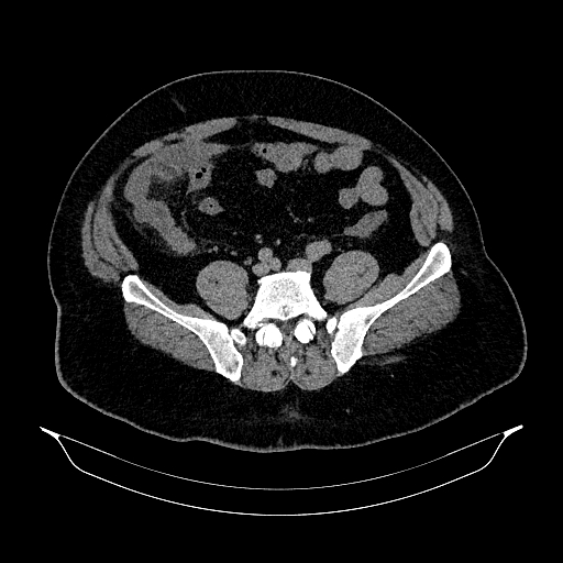 File:Acute appendicitis (Radiopaedia 79950-93224 Axial non-contrast 72).jpg
