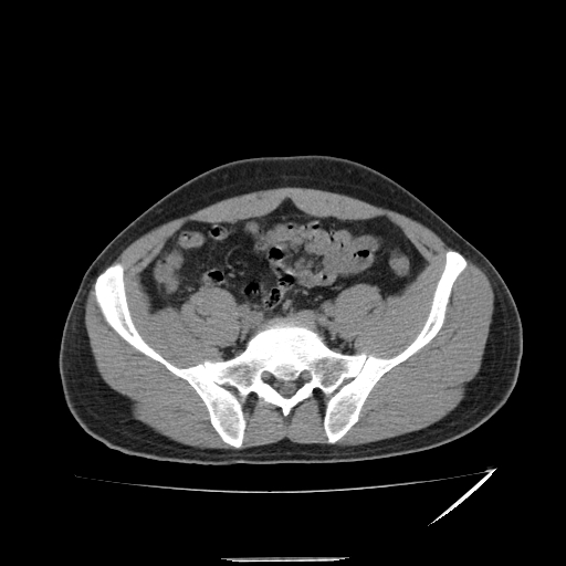 File:Acute appendicitis (Radiopaedia 81320-95015 A 18).jpg