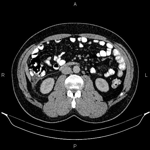 Acute appendicitis (Radiopaedia 84780-100240 Axial C+ portal venous phase 51).jpg