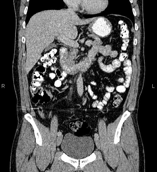 Acute appendicitis (Radiopaedia 84780-100240 Coronal C+ portal venous phase 35).jpg