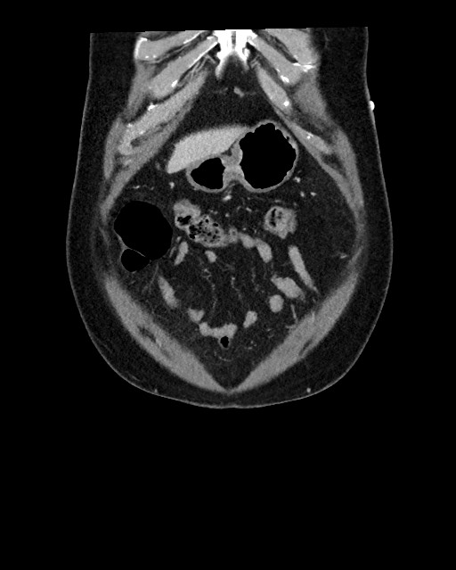Acute appendicitis - large appendicoliths (Radiopaedia 61805-69820 Coronal C+ portal venous phase 25).jpg