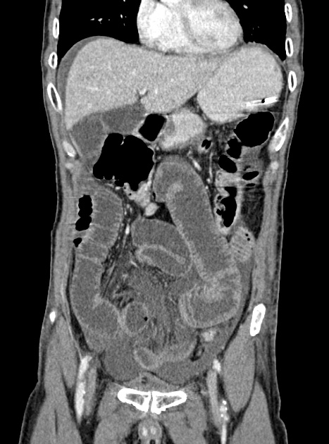 Acute bowel ischemia (Radiopaedia 87695-104114 Coronal C+ portal venous phase 147).jpg