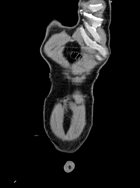 Acute bowel ischemia (Radiopaedia 87695-104114 Coronal C+ portal venous phase 68).jpg